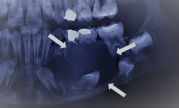 dentigerous cyst التكيس المسنن قد يحدث حول الأسنان المدفونة - موقع تقويم الاسنان